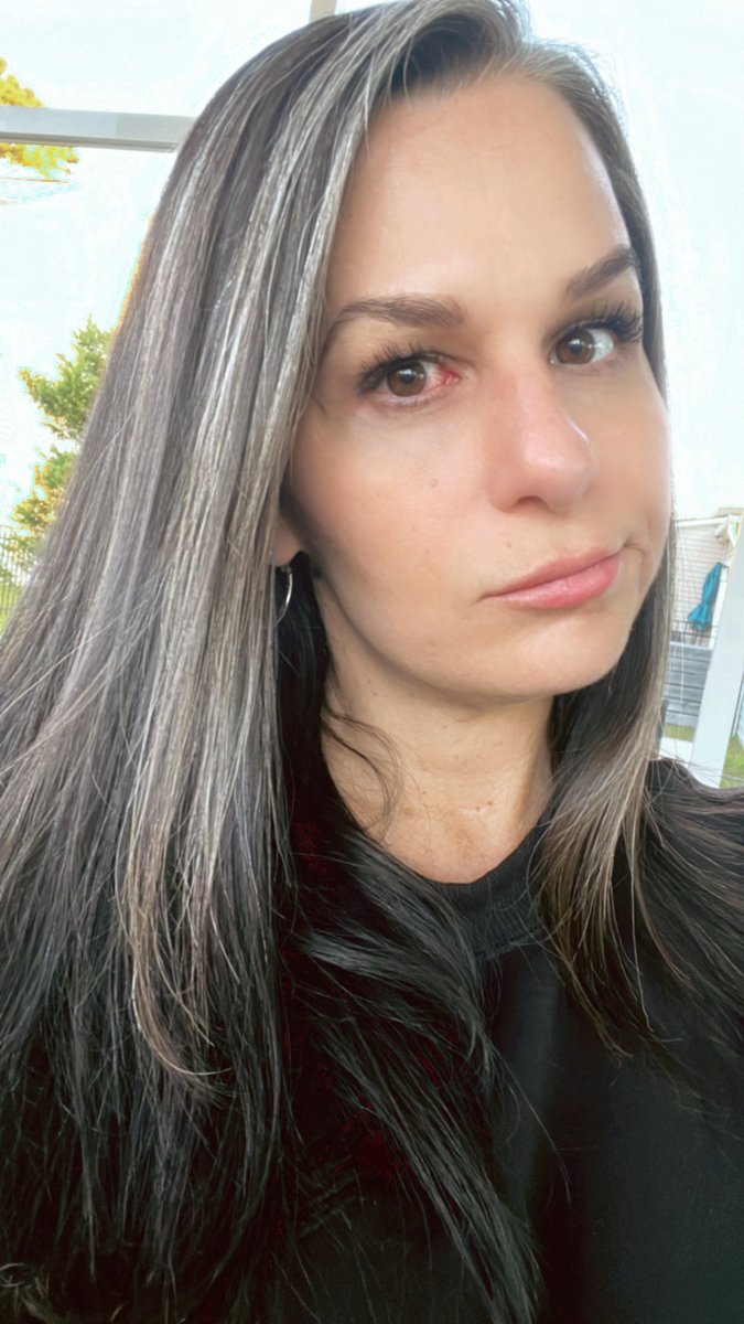 AmCapTrader's tweet photo. When you have to have tear duct surgery 18 months after cancer radiation treatment because they fused shut but there’s only an 85% success rate… and you are the 15% and have to have another surgery 🤦🏻♀️ #cuckfancer https://t.co/omr3PcMkS5