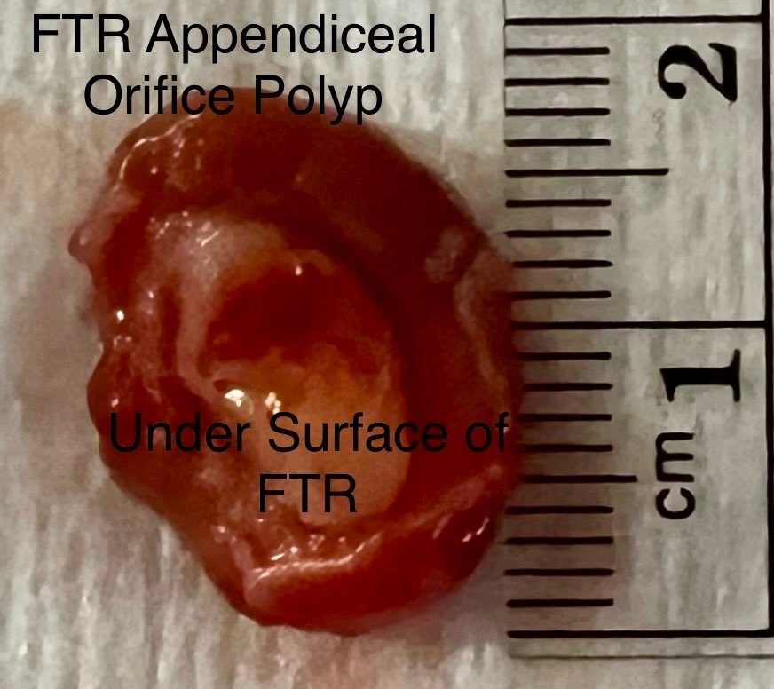 EUSandEndoscopy's tweet photo. A previously incompletely resected #SessileSerratedAdenoma at OSH in the #AppendicealOrifice completely removed w clear margins by full thickness resection #FTR using #OVESCO #FTRD https://t.co/cjmUianS3m