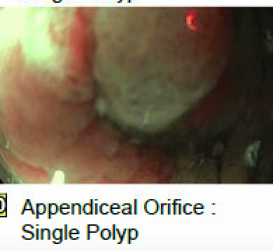 EUSandEndoscopy's tweet photo. A previously incompletely resected #SessileSerratedAdenoma at OSH in the #AppendicealOrifice completely removed w clear margins by full thickness resection #FTR using #OVESCO #FTRD https://t.co/cjmUianS3m