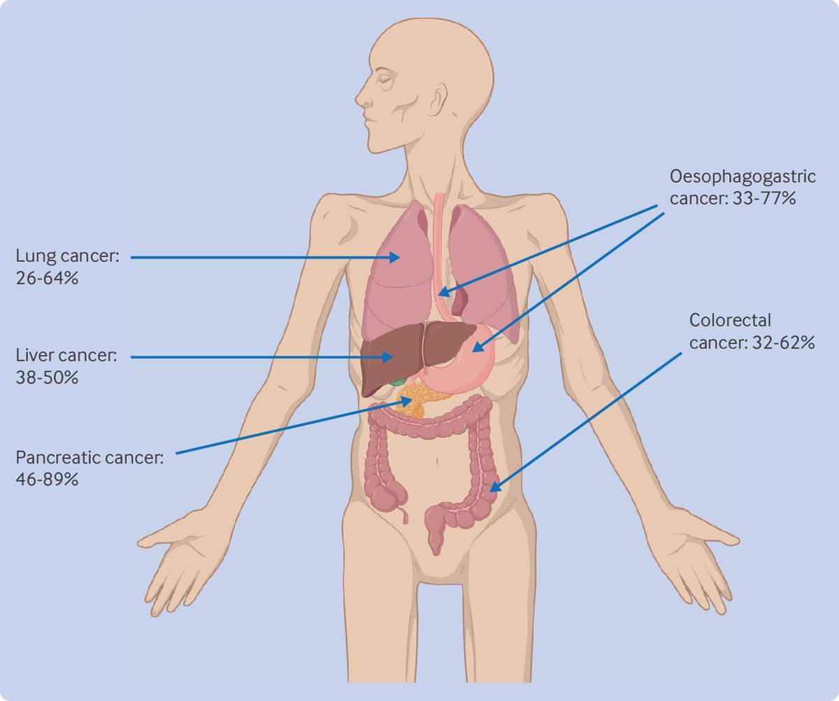 Cancer cachexia is a complex syndrome characterised by tissue loss, decreased appetite, fatigue, and reduced activity in patients with cancer.

This article provides a clinical update drawing on contemporary research and guidelines
🔗 bmj.com/content/387/bm…