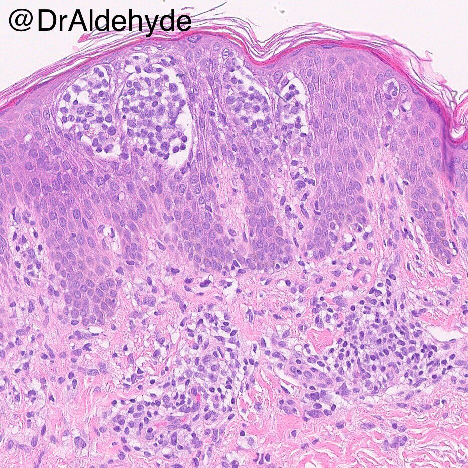 DrAldehyde's tweet photo. Exciting news: #USCAP2025 abstract submission results are in, and they came out quickly, just like last year! All 7 of our abstracts (4 with me as the PI) have been accepted. Congrats to the amazing fellows and residents who worked with me this year! 😆🎉🔬

#MDACCPath #dermpath https://t.co/lLA9tyFab6
