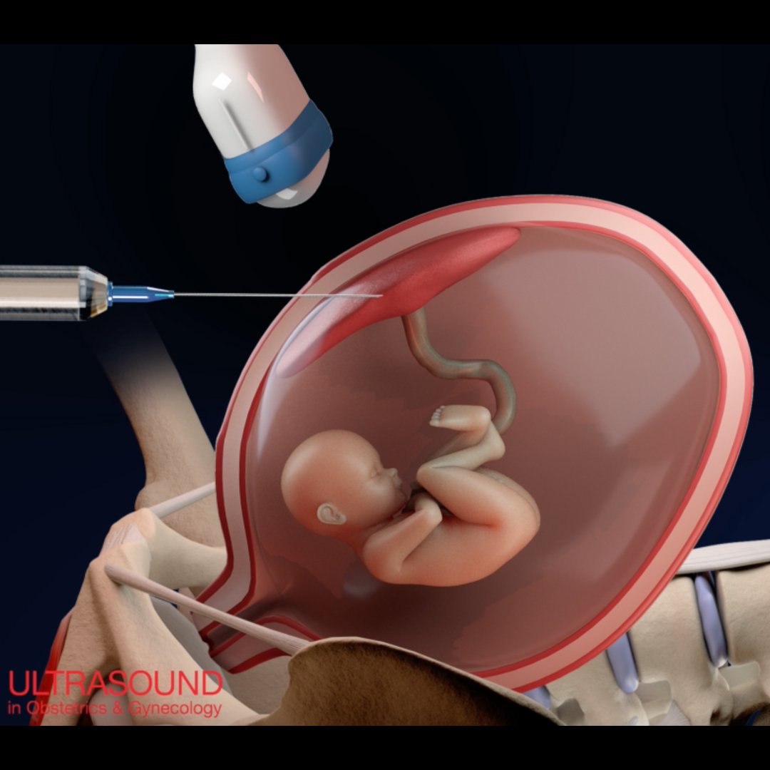 Replacing invasive testing with NIPT for high-risk pregnancies would substantially decrease the first-trimester detection of pathogenic chromosomal anomalies’, finds new #UOGjournal #freeaccess article by Gadsbøll et al. Read the full article here:  bit.ly/3XT7S9v