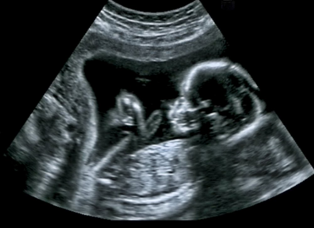 johnrackham82's tweet photo. This is a human being. 

Abortion is murder. https://t.co/7OTb8Y954G