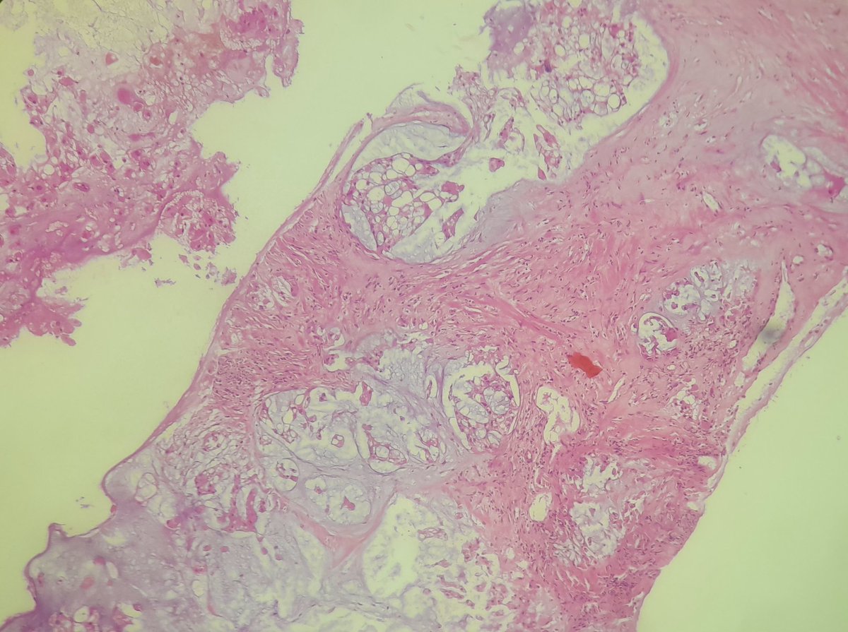 AlesawiHanadi's tweet photo. An osteolytic sacral lesion. Conventional chordoma.
#STPath #PathX https://t.co/km5m096ghL