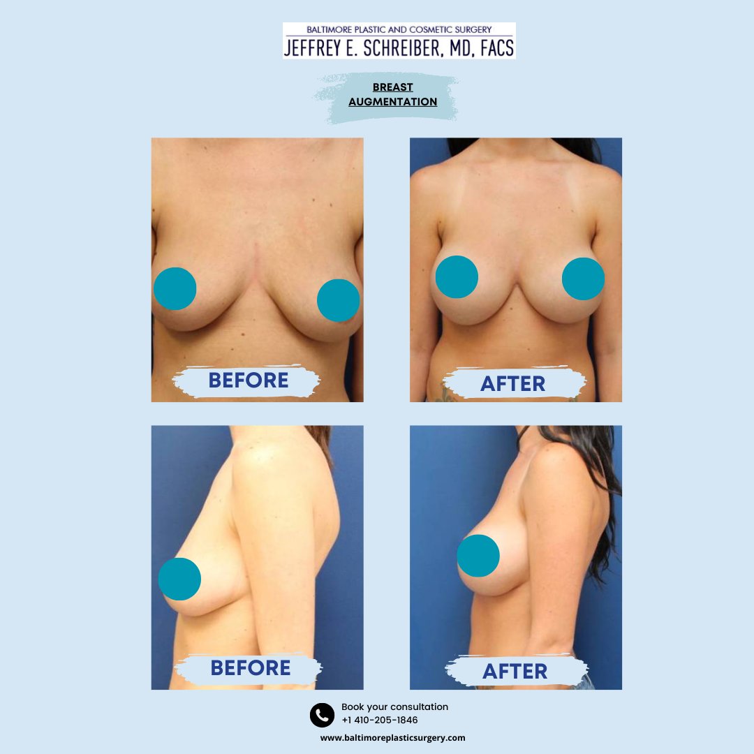 ePlasticSurgery's tweet photo. This 24-year-old enhanced her breast shape and size with 800cc high-profile implants over the muscle. Six months later, she’s loving her stunning transformation! ✨

Call us at (410) 205-1846.

#BreastAugmentation #BaltimorePlasticSurgery https://t.co/TYJZwusYaV
