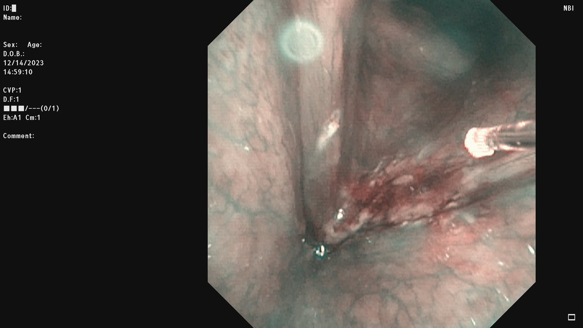 STLvoicedoc's tweet photo. In-office awake laser treatment for laryngeal issues, like #dysplasia or #vocalpolyps, is an effective option. Patients experience less downtime. This innovative approach allows for quicker recovery and more comfort.

#laryngology #ENTCare #LaserSurgery #InOfficeProcedure https://t.co/8GEs4HtOHN
