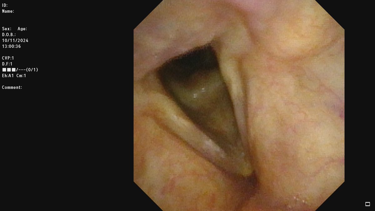 STLvoicedoc's tweet photo. In-office awake laser treatment for laryngeal issues, like #dysplasia or #vocalpolyps, is an effective option. Patients experience less downtime. This innovative approach allows for quicker recovery and more comfort.

#laryngology #ENTCare #LaserSurgery #InOfficeProcedure https://t.co/8GEs4HtOHN