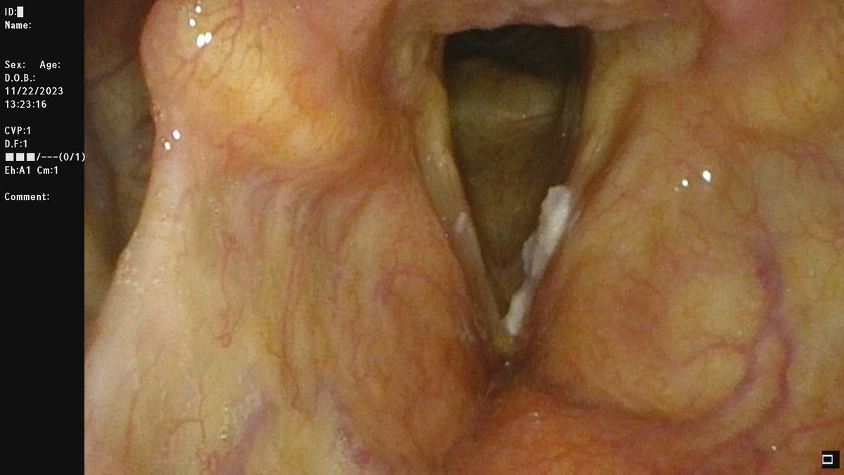 STLvoicedoc's tweet photo. In-office awake laser treatment for laryngeal issues, like #dysplasia or #vocalpolyps, is an effective option. Patients experience less downtime. This innovative approach allows for quicker recovery and more comfort.

#laryngology #ENTCare #LaserSurgery #InOfficeProcedure https://t.co/8GEs4HtOHN