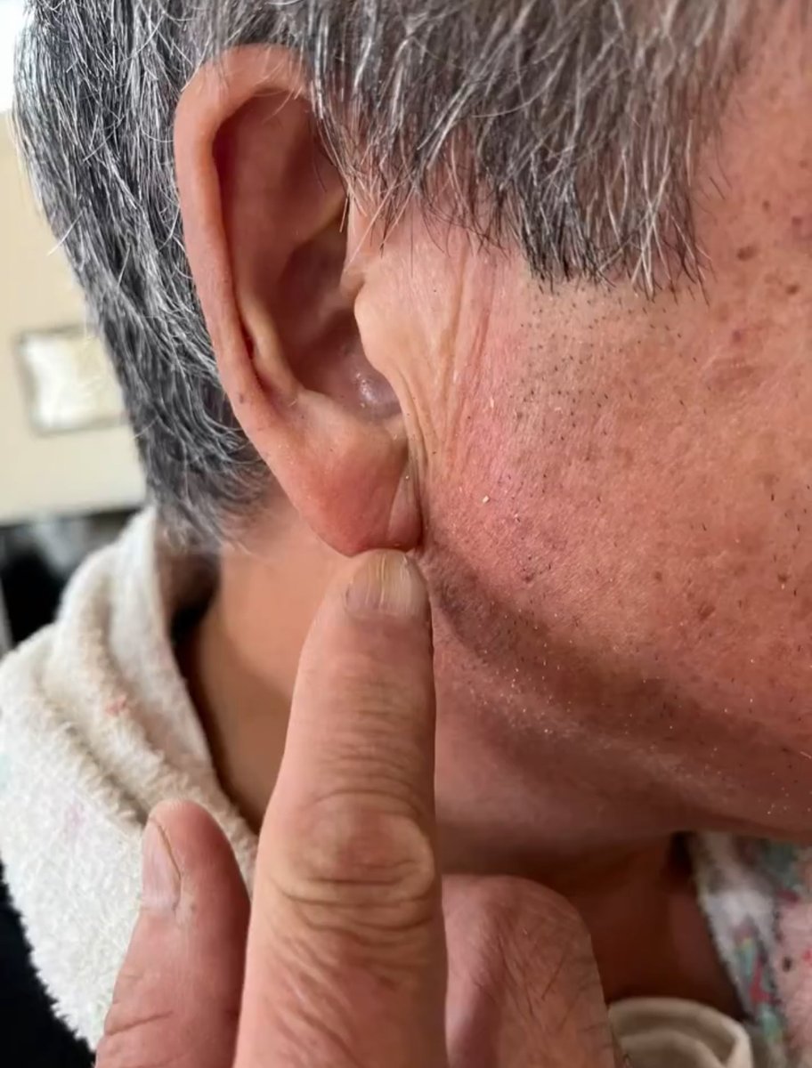 大切なこといいます。「耳たぶのシワ」ミオトスとﾀﾋぬほど危険。看護師として働いていたとき、医師に加齢によるものじゃないですかとろくすっぽ調べもせずに報告した僕はバチクソ怒られました。"フランクサイン"といって血管ガッチガチのサイン。右にできるとお酒の飲み過ぎで肝臓が弱ってたり左に..