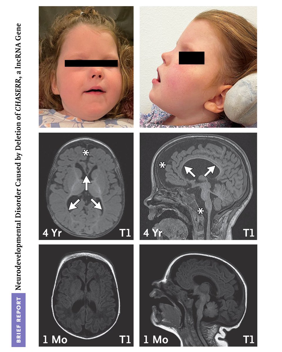 Deletions in a gene (𝘊𝘏𝘈𝘚𝘌𝘙𝘙) that encodes a long noncoding RNA cause severe developmental delay and an increase in expression of a neighboring gene, 𝘊𝘏𝘋2. Read the Brief Report: nej.md/48gS1WY