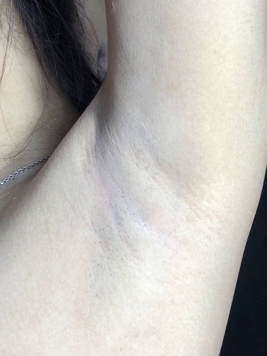 INI SERIUS EFFORTLESS BGT GAPAKE SAKIT ☝🏻😭

ini lebih ke gada rasanya sihh😭 ga cekit cekit ga sakitt dan ga lecett 🥹 segampang itu lohhh  mana sat set juga aaaaa sukakk!!! 

(Disclaimer ini asli ya foto akuuu real keti aku)