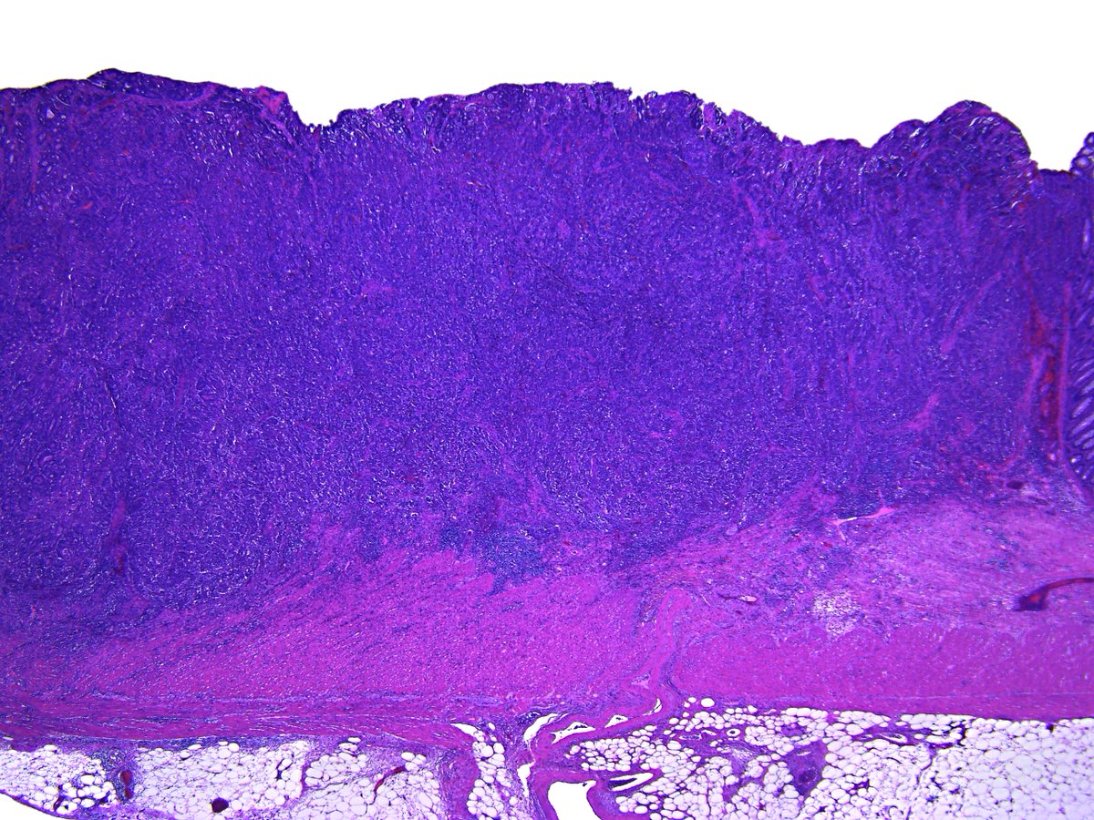 Pathology Walker@Auto Tweet Bot tweet media