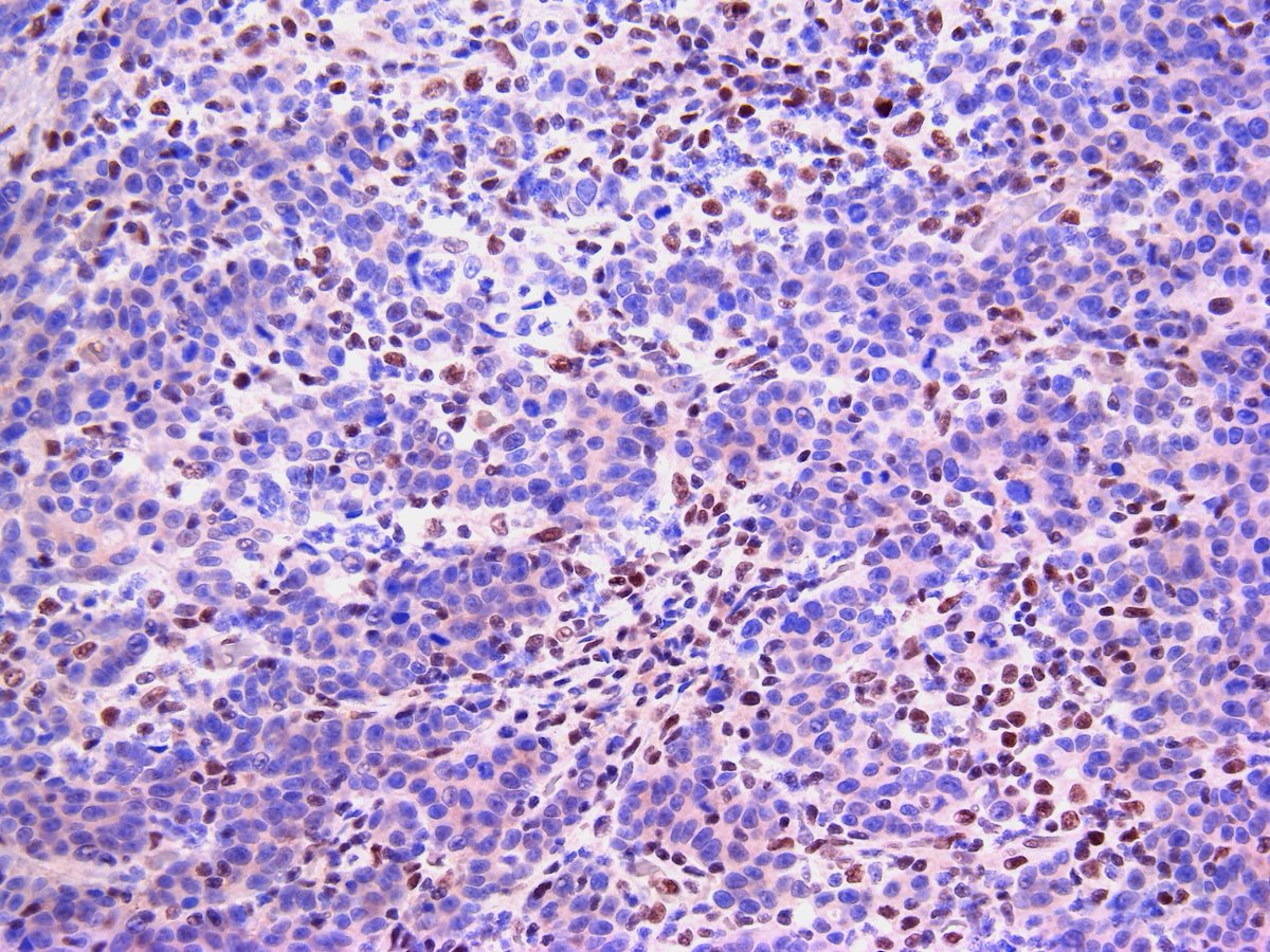 Pathology Walker@Auto Tweet Bot tweet media