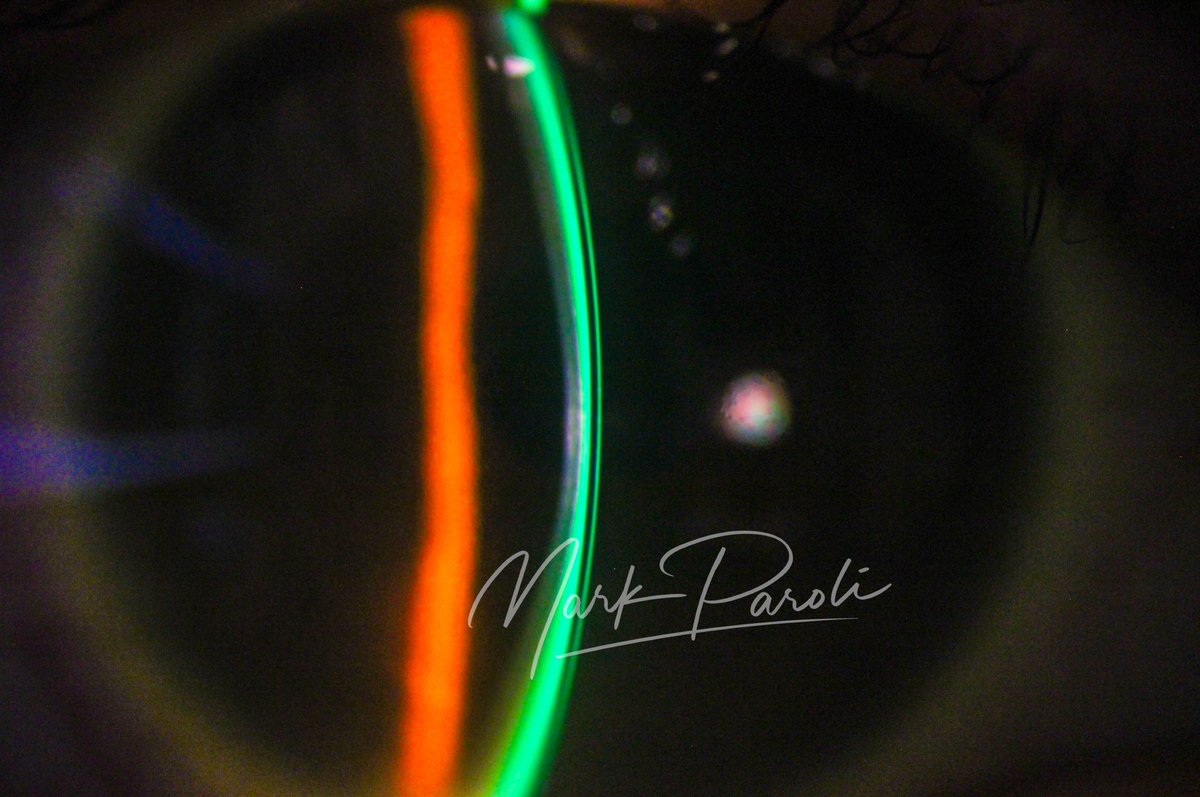 its_MarkParoli's tweet photo. 20/20 Vision with Scleral Lenses for Keratoconus! 🌟

Achieved crystal-clear results for a patient with significant corneal irregularities. They’ve never seen better!

📞 +63 915 860 0555 | 📧

#ScleralLenses #Keratoconus #Optometrist #Ophthalmologist #Philippines https://t.co/lO9A7x6xll