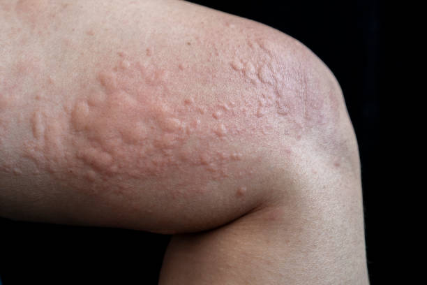 getnurut's tweet photo. 1 of the main reason I nak start balik buat bone broth is bcs my urticaria/gegata problem dah start balik.

I hate the itchiness and what I hate most is gatal nauzubillah tu kacau waktu i tidur.

Tengah tidur mati tiba² 4am terjaga gatal² 1 badan.

Gambar Google.
#NurutProject https://t.co/lFfMUzEpHC