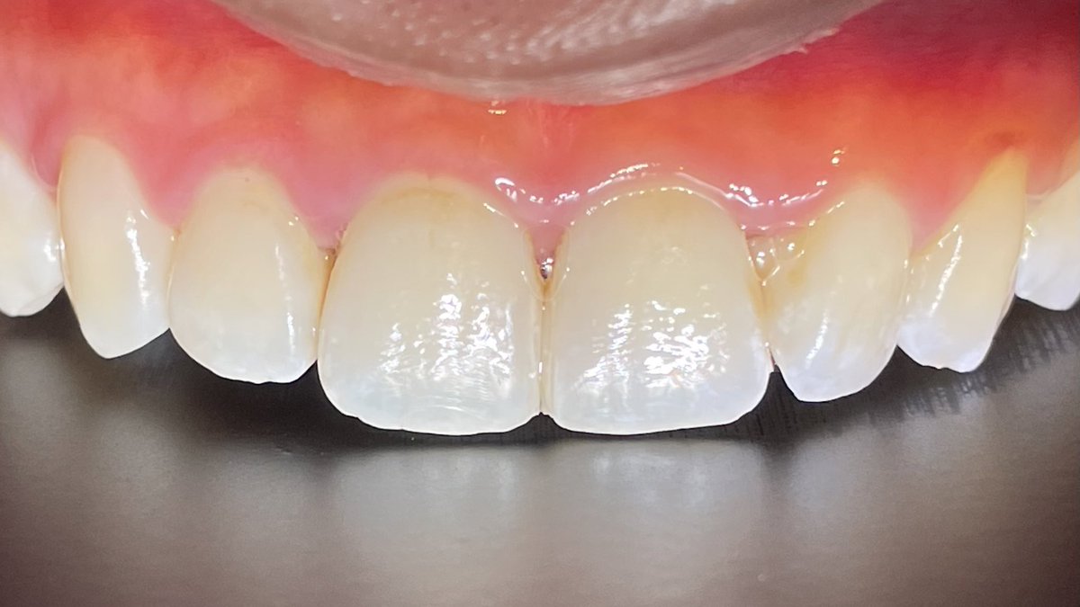 cyannidley's tweet photo. Class III Resin Composite Restoration

Before.                                       After https://t.co/ZtaXxxVT30