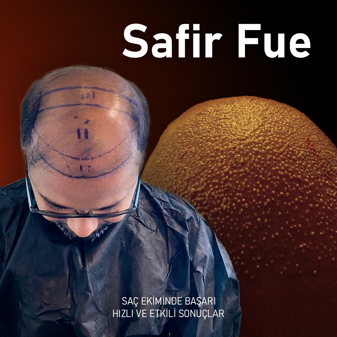 SAFİR FUE EKİM SONUCU VE SAÇ ÇİZGİSİYLE GÖZ KAMAŞTIRAN DEĞİŞİM! UTOPIA İLE DOĞAL VE GÜZEL SONUÇLAR ALIN! 

🚀 +90 552 825 17 12
💫 utopiahairclinic.com
🚘 info@utopiaturkey.com
❤️ Kadıköy / İstanbul / Türkiye
#sapphirefue #hairtransplant #hairline #utopiahairclinic