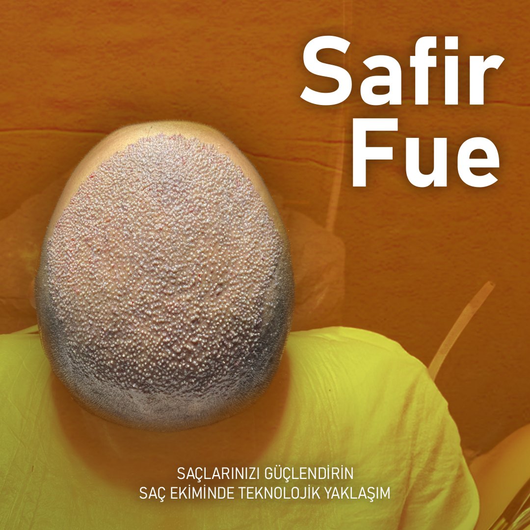 5500 GREFT EKİLMİŞ GÖRSELİYLE YENİ BİR GÖRÜNÜM! UTOPIA İLE SAÇLARINIZDAKİ DEĞİŞİMİ KEŞFEDİN! 
🚀 +90 552 825 17 12
💫 utopiahairclinic.com
🚘 info@utopiaturkey.com
❤️ Kadıköy / İstanbul / Türkiye
#5500grafts #hairtransplant #beforeandafter #utopiahairclinic #naturalresults