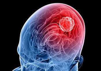 CRCT-Oncopole (@crctoncopole) on Twitter photo Neuro-oncologie : DRIM, nouvelle méthode de prédiction de l’analyse de survie présentée au congrès MICCAI par Lucas Robinet de l'équipe <a href="/Moyal_lab/">RADOPT_CRCT</a> du <a href="/crctoncopole/">CRCT-Oncopole</a> , <a href="/IUCTOncopole/">IUCT Oncopole</a> , <a href="/IRIToulouse/">IRIToulouse</a>
➡️crct-inserm.fr/neuro-oncologi… Neuro-oncologie : DRIM, nouvelle méthode de prédiction de l’analyse de survie présentée au congrès MICCAI par Lucas Robinet de l'équipe <a href="/Moyal_lab/">RADOPT_CRCT</a> du <a href="/crctoncopole/">CRCT-Oncopole</a> , <a href="/IUCTOncopole/">IUCT Oncopole</a> , <a href="/IRIToulouse/">IRIToulouse</a>
➡️crct-inserm.fr/neuro-oncologi…
