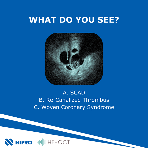 Sharpen your image interpretation skills during one of the fifteen Image Interpretation Training workshops during #TCT2024. 

Don’t miss an opportunity to learn from the experts and see case examples with Gentuity HF-OCT.

Test your knowledge, and add your answer in the comments!