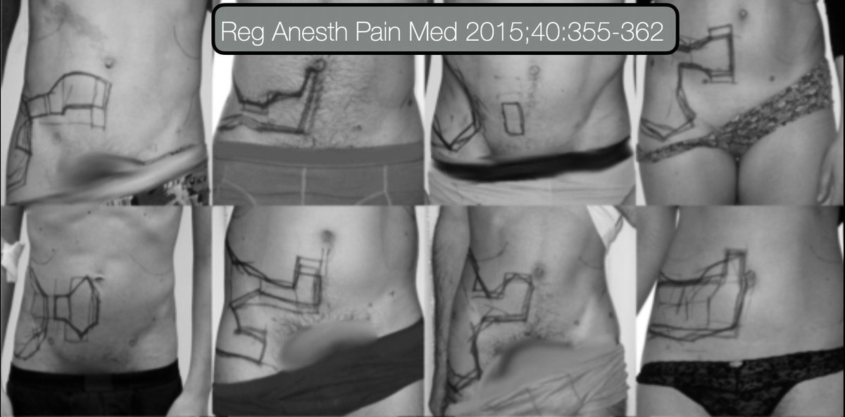 Jeff Gadsden (@jeffgadsden) on Twitter photo <a href="/Duke_Anesthesia/">Duke Anesthesiology</a> <a href="/amit_pawa/">Dr Amit Pawa💉🎙️</a> <a href="/GongGasGirl/">Tanya</a> <a href="/ashwani_doc/">Ashwani Gupta</a> <a href="/fuzzymittens/">MiMi</a> <a href="/EMARIANOMD/">Ed Mariano, MD, MAS, FASA, FASRA 🇺🇸🇵🇭</a> <a href="/EM_RESUS/">Sam Ghali, M.D.</a> <a href="/OrlandoRPN/">Orlando R. Pérez-Nieto</a> <a href="/ASRA_Society/">ASRA Pain Medicine</a> <a href="/ESRA_Society/">ESRA | European Society of Regional Anaesthesia</a> <a href="/ESRA_trainees/">ESRA Trainees</a> <a href="/JTraumAcuteSurg/">Journal of Trauma and Acute Care Surgery</a> <a href="/Assoc_Anaes/">Association of Anaesthetists</a> <a href="/AoraIndia/">AORA India</a> <a href="/tsmurali/">Murali Thondebhavi</a> <a href="/Wilkinsonjonny/">Jonny Wilkinson</a> <a href="/Nadia_Hdz_MD/">Nadia Hernandez, MD, FASA</a> <a href="/anesthesiadocmd/">Melody Anderson (Herman), MD</a> <a href="/RCoANews/">Royal College of Anaesthetists</a> <a href="/Ron_George/">Dr. Ron George 🇨🇦 #Anesthesiologist</a> <a href="/dr_ibuprofeno/">Dr. Diego Midino💊</a> <a href="/diazolam/">Miguel Díaz</a> <a href="/DrSleep88/">D r. S u e ñ o</a> <a href="/morefluids/">Sethina Watson</a> <a href="/RegionalAnaesUK/">RA-UK</a> <a href="/mswami001/">Madhav Swaminathan</a> <a href="/drp297/">Dave Price</a> <a href="/PedsAnesNet/">PedsAnesthesia.Net 😷</a> <a href="/CASUpdate/">Canadian Anesthesiologists' Society</a> <a href="/curromir/">Curro Miralles</a> <a href="/Paul_Wischmeyer/">Paul Wischmeyer MD</a> <a href="/paulhting/">Paul H. Ting</a> <a href="/NarouzeMD/">Samer Narouze,MD,PhD,MMM</a> <a href="/emilysharpe/">Emily Sharpe, MD, FASA</a> <a href="/James_Kim_MD/">James K. Kim</a> <a href="/ajrmacfarlane/">Alan Macfarlane</a> <a href="/AlanaFlex/">Dr. Alana Flexman</a> <a href="/nelkassabany/">Nabil Elkassabany MD MBA MSCE</a> <a href="/bobfunn/">bob funnekotter</a> <a href="/OBsleepmerchant/">Simon Ash</a> <a href="/ruthi_landau/">Dr. Ruthi Landau</a> <a href="/TomJelic/">Tom Jelic</a> <a href="/DrNavSidhu/">Dr Nav Sidhu</a> <a href="/snouzin/">A/Prof Suzi Nou @snouzin.bsky.social</a> <a href="/mick_kerr/">michael kerr</a> <a href="/L_D_White/">Leigh White</a> <a href="/acopand/">cassandrews 🇦🇺🏡</a> <a href="/noolslucas/">Nuala Lucas</a> <a href="/UCSFAnesthesia/">UCSF Anesthesia and Perioperative Care</a> <a href="/Stanford_RAAPM/">Stanford RAAPM</a> The other way I failed early on is by placing my needle in the TA plane, injecting all the local in one spot, and walking away, high-fiving my colleagues. We began to realize we were seeing unusual patterns of sensory loss and getting failures, like in this study: #Blocktober24 <a href="/Duke_Anesthesia/">Duke Anesthesiology</a> <a href="/amit_pawa/">Dr Amit Pawa💉🎙️</a> <a href="/GongGasGirl/">Tanya</a> <a href="/ashwani_doc/">Ashwani Gupta</a> <a href="/fuzzymittens/">MiMi</a> <a href="/EMARIANOMD/">Ed Mariano, MD, MAS, FASA, FASRA 🇺🇸🇵🇭</a> <a href="/EM_RESUS/">Sam Ghali, M.D.</a> <a href="/OrlandoRPN/">Orlando R. Pérez-Nieto</a> <a href="/ASRA_Society/">ASRA Pain Medicine</a> <a href="/ESRA_Society/">ESRA | European Society of Regional Anaesthesia</a> <a href="/ESRA_trainees/">ESRA Trainees</a> <a href="/JTraumAcuteSurg/">Journal of Trauma and Acute Care Surgery</a> <a href="/Assoc_Anaes/">Association of Anaesthetists</a> <a href="/AoraIndia/">AORA India</a> <a href="/tsmurali/">Murali Thondebhavi</a> <a href="/Wilkinsonjonny/">Jonny Wilkinson</a> <a href="/Nadia_Hdz_MD/">Nadia Hernandez, MD, FASA</a> <a href="/anesthesiadocmd/">Melody Anderson (Herman), MD</a> <a href="/RCoANews/">Royal College of Anaesthetists</a> <a href="/Ron_George/">Dr. Ron George 🇨🇦 #Anesthesiologist</a> <a href="/dr_ibuprofeno/">Dr. Diego Midino💊</a> <a href="/diazolam/">Miguel Díaz</a> <a href="/DrSleep88/">D r. S u e ñ o</a> <a href="/morefluids/">Sethina Watson</a> <a href="/RegionalAnaesUK/">RA-UK</a> <a href="/mswami001/">Madhav Swaminathan</a> <a href="/drp297/">Dave Price</a> <a href="/PedsAnesNet/">PedsAnesthesia.Net 😷</a> <a href="/CASUpdate/">Canadian Anesthesiologists' Society</a> <a href="/curromir/">Curro Miralles</a> <a href="/Paul_Wischmeyer/">Paul Wischmeyer MD</a> <a href="/paulhting/">Paul H. Ting</a> <a href="/NarouzeMD/">Samer Narouze,MD,PhD,MMM</a> <a href="/emilysharpe/">Emily Sharpe, MD, FASA</a> <a href="/James_Kim_MD/">James K. Kim</a> <a href="/ajrmacfarlane/">Alan Macfarlane</a> <a href="/AlanaFlex/">Dr. Alana Flexman</a> <a href="/nelkassabany/">Nabil Elkassabany MD MBA MSCE</a> <a href="/bobfunn/">bob funnekotter</a> <a href="/OBsleepmerchant/">Simon Ash</a> <a href="/ruthi_landau/">Dr. Ruthi Landau</a> <a href="/TomJelic/">Tom Jelic</a> <a href="/DrNavSidhu/">Dr Nav Sidhu</a> <a href="/snouzin/">A/Prof Suzi Nou @snouzin.bsky.social</a> <a href="/mick_kerr/">michael kerr</a> <a href="/L_D_White/">Leigh White</a> <a href="/acopand/">cassandrews 🇦🇺🏡</a> <a href="/noolslucas/">Nuala Lucas</a> <a href="/UCSFAnesthesia/">UCSF Anesthesia and Perioperative Care</a> <a href="/Stanford_RAAPM/">Stanford RAAPM</a> The other way I failed early on is by placing my needle in the TA plane, injecting all the local in one spot, and walking away, high-fiving my colleagues. We began to realize we were seeing unusual patterns of sensory loss and getting failures, like in this study: #Blocktober24