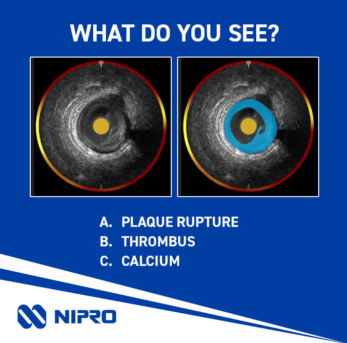 Looking to fine-tune your Image Interpretation skills? You’re in luck! Join us at TCT in Washington, DC this year.

Hands on training sessions are taking place Monday, Tuesday and Wednesday, find the one that best fits your schedule.

#TCT2024 #imaging #imageinterpretation #IVUS