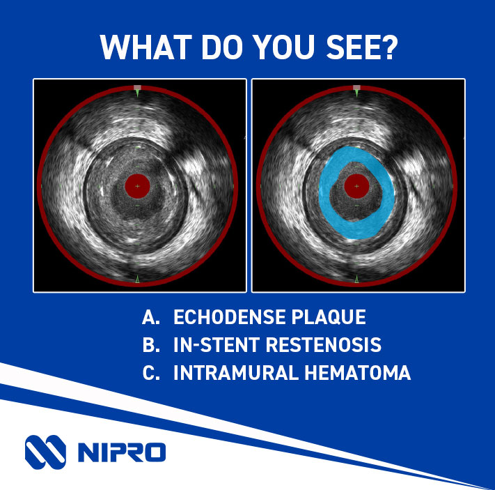 Looking to fine-tune your Image Interpretation skills? You’re in luck! Join us at TCT in Washington, DC this year.

Hands on training sessions are taking place Monday, Tuesday and Wednesday, find the one that best fits your schedule.

#TCT2024 #imaging #imageinterpretation #IVUS