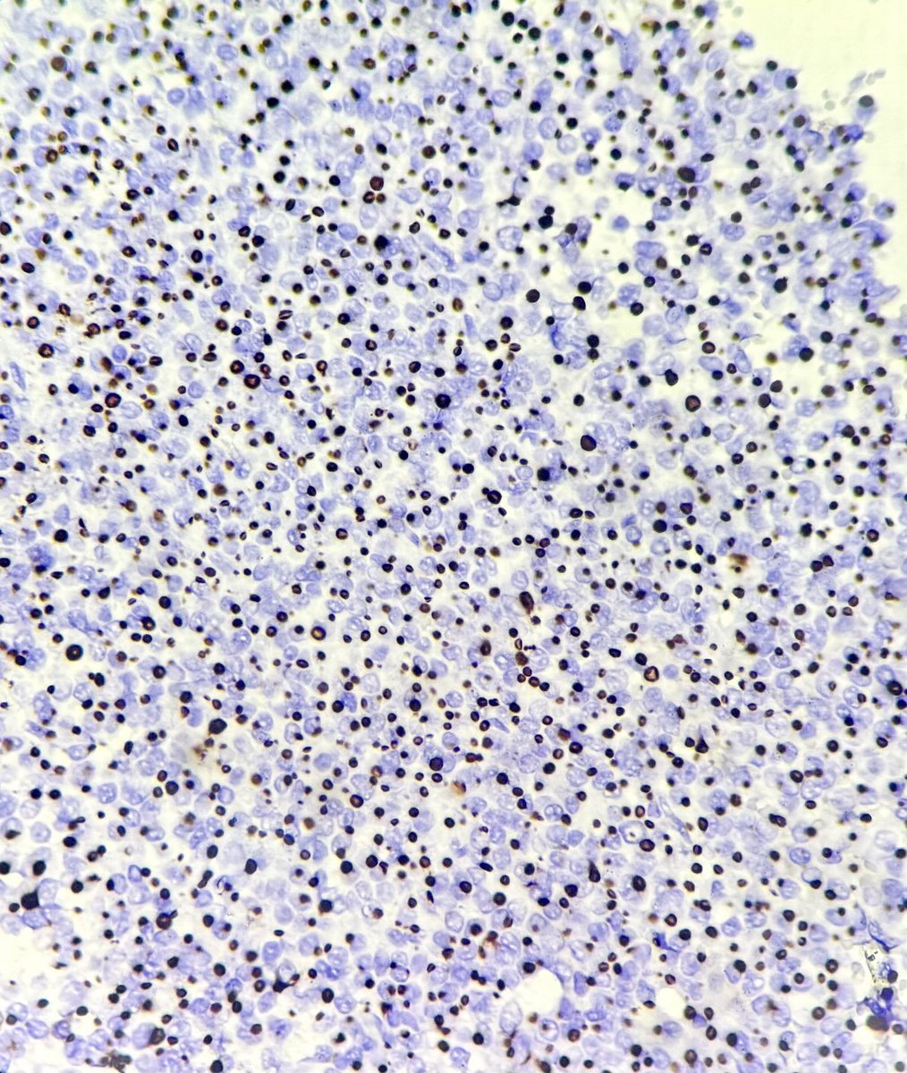#Pituitaryadenoma 
Could you tell the ihc marker?

#pathology #pathX #pathresidents #cnspath