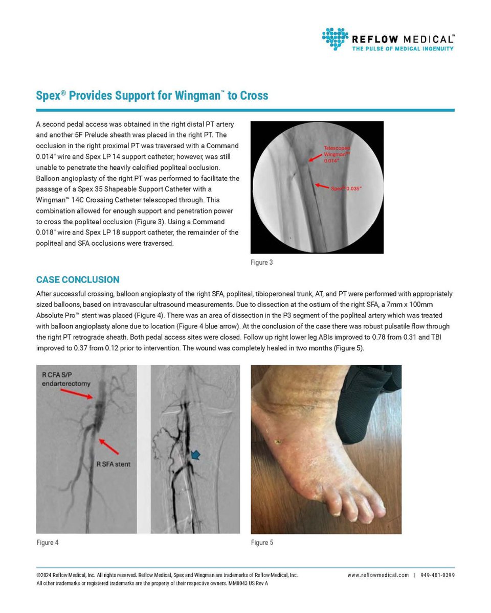 ReflowMedical (@reflowmedical) on Twitter photo "Good tools to have in the CLTI toolbox for tough cases like this.” Dr. Ashkan Karimi <a href="/ashkan_1670/">Ashkan Karimi MD, FACC, RPVI</a> comments on the Reflow Medical Spex® Shapeable Support Catheters and Wingman™ CTO Crossing Catheter in a complex case study.
To learn more, view and download his case report at: "Good tools to have in the CLTI toolbox for tough cases like this.” Dr. Ashkan Karimi <a href="/ashkan_1670/">Ashkan Karimi MD, FACC, RPVI</a> comments on the Reflow Medical Spex® Shapeable Support Catheters and Wingman™ CTO Crossing Catheter in a complex case study.
To learn more, view and download his case report at: