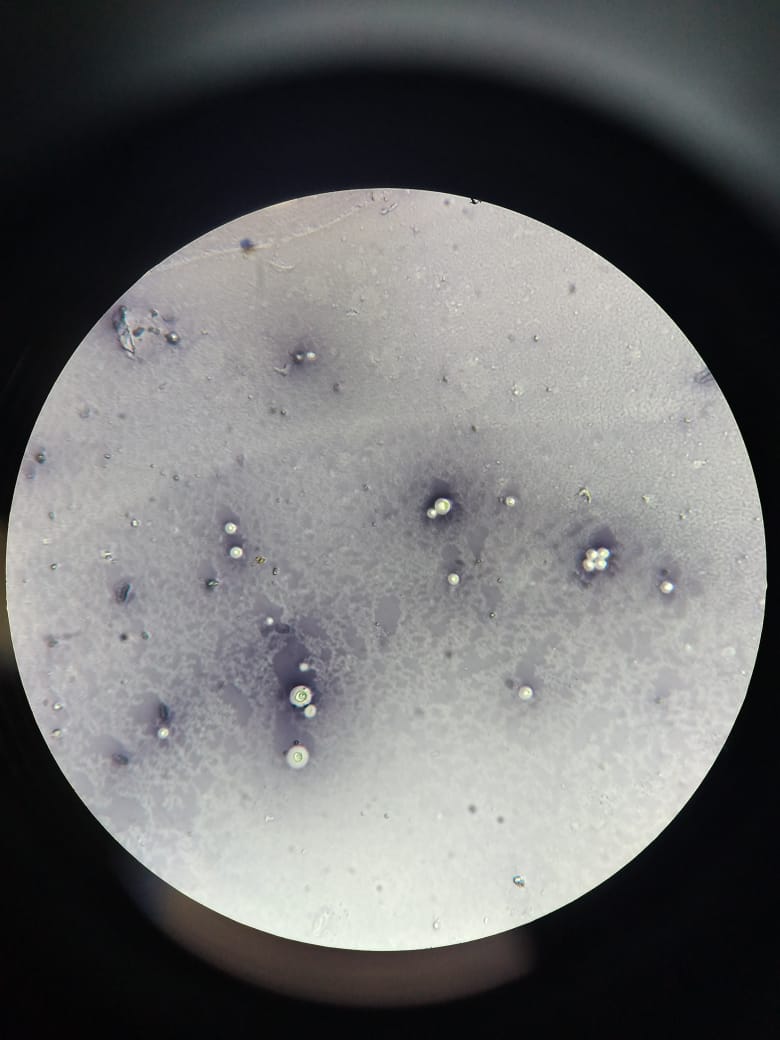 India ink showing budding yeast in CSF