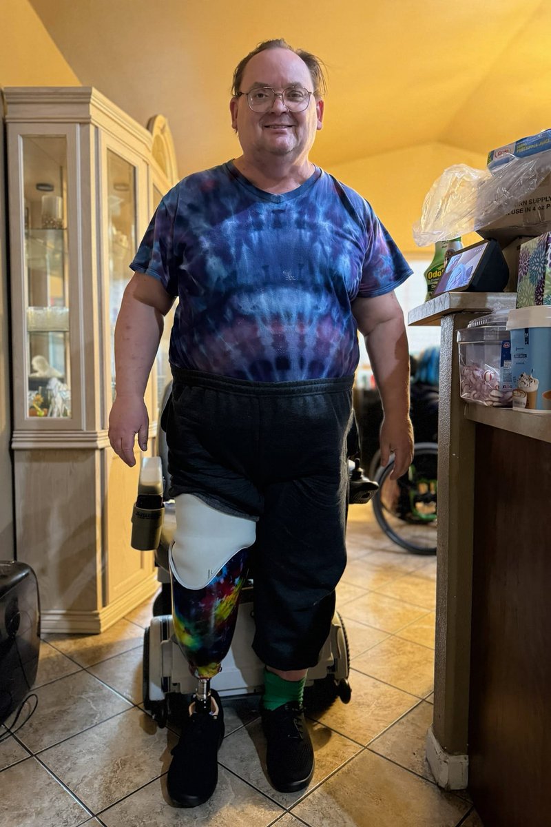 I just got my new prosthetic leg.  I tie dyed the material and they laminated it into the socket.  Freaking awesome.  Now I just have to learn to walk again.