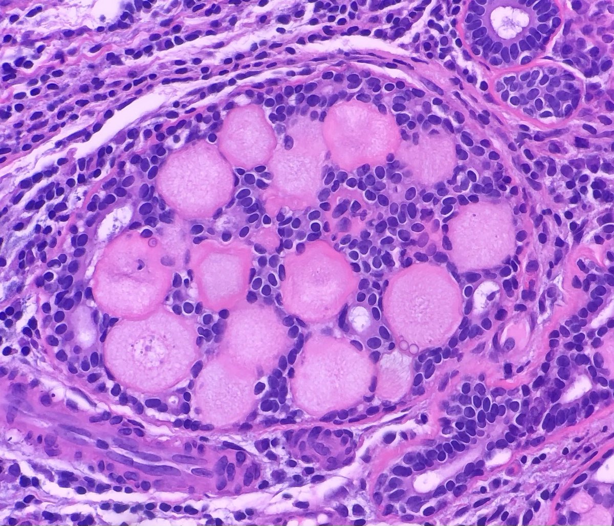 Breast - Collagenous spherulosis 🔬 #pathology #pathtwitter #Breastpath