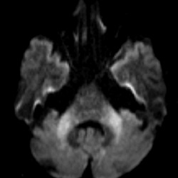 #AJNRcow >> October 24, 2024 >> A 54-year-old man presents with history of episodic loss of consciousness for the last 6 months. There are no focal neurologic deficits and bilateral mild to moderate sensorineural hearing loss. View the case ow.ly/vnXT50TSMcY.