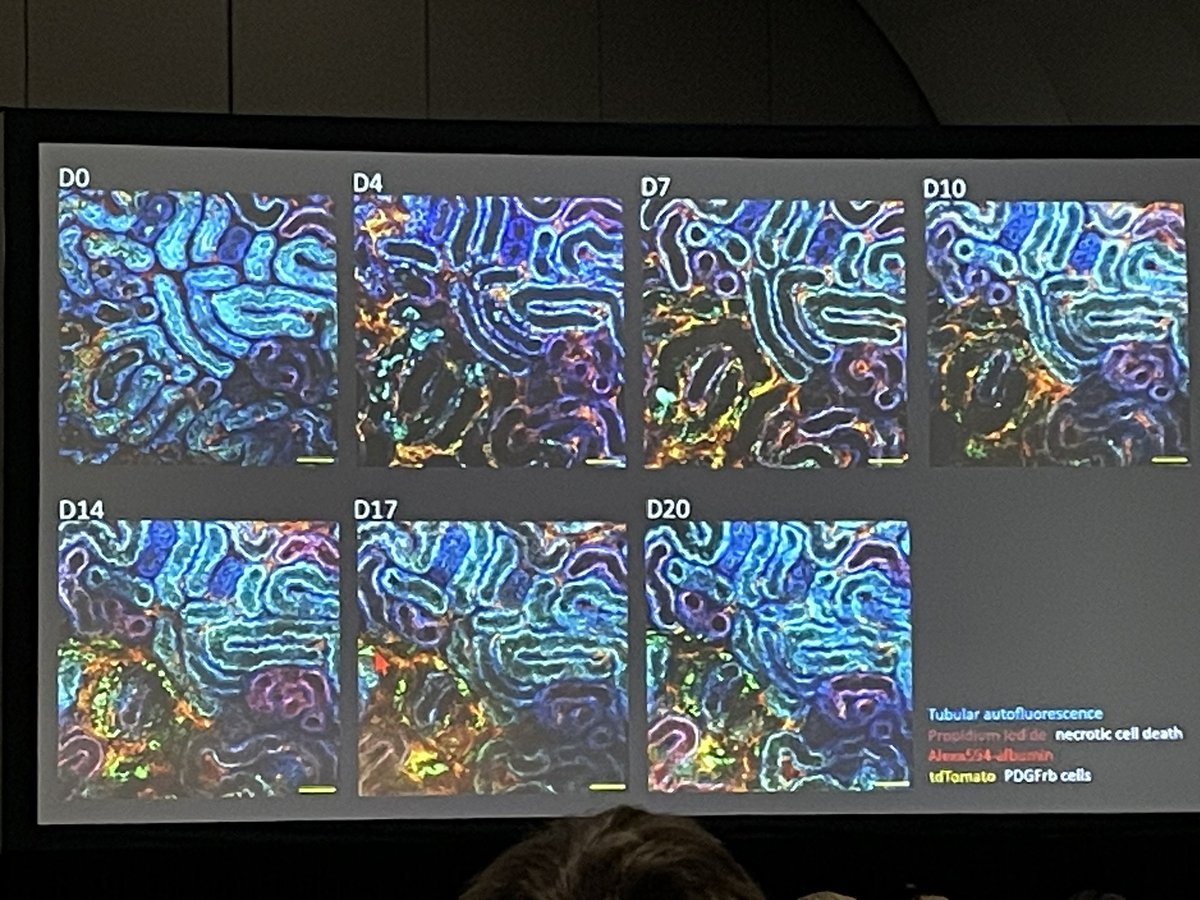 Michael S. Balzer (@ms_balzer) on Twitter photo Is fibrosisšorš„? Fantastic talk in the spatial session by <a href="/Ina_M_Schiessl/">Ina Maria Schiessl</a> on intravital tracking of kidney tubules. #kidneyweek2024 #kidneyweek Is fibrosisšorš„? Fantastic talk in the spatial session by <a href="/Ina_M_Schiessl/">Ina Maria Schiessl</a> on intravital tracking of kidney tubules. #kidneyweek2024 #kidneyweek