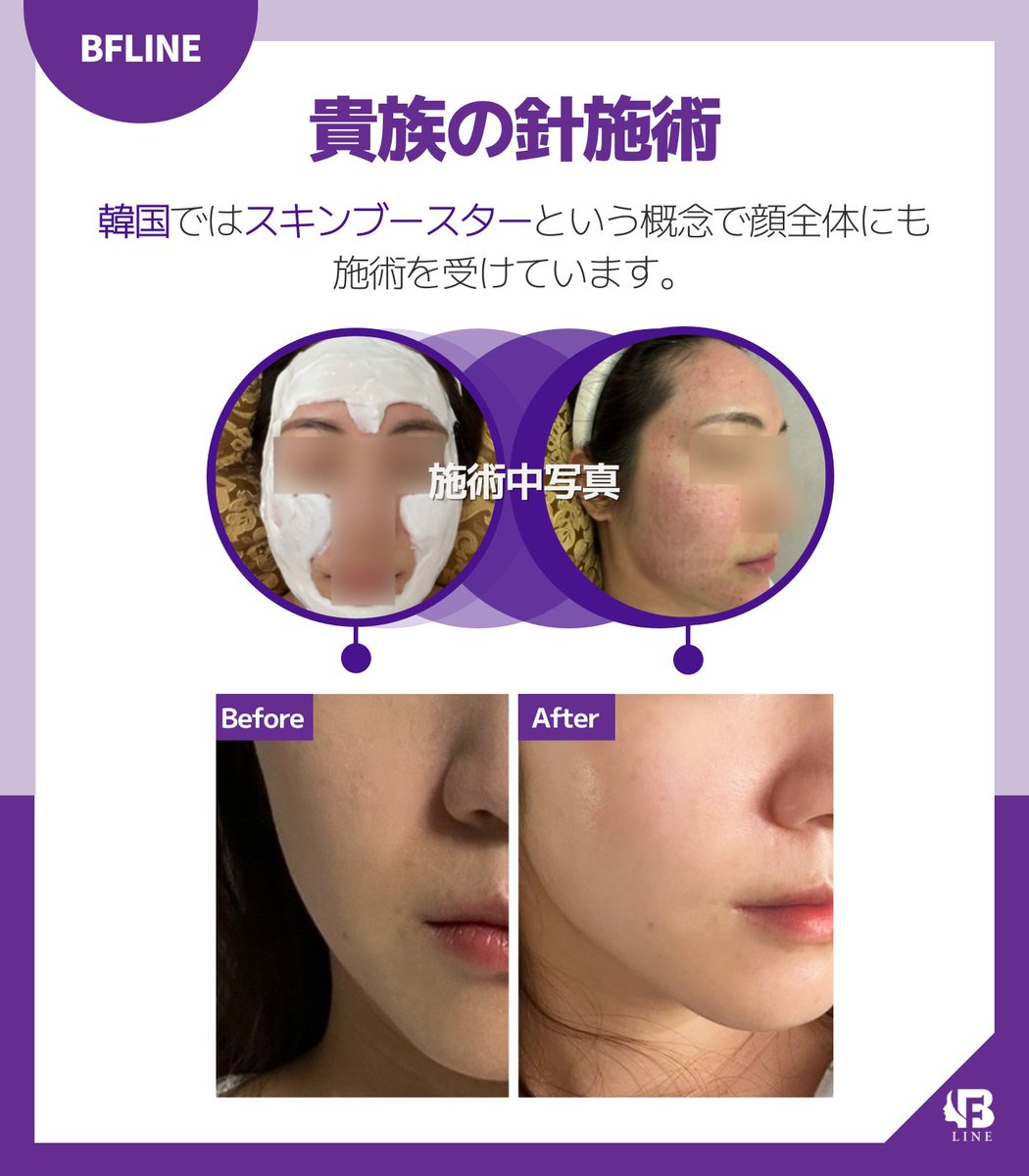 bflinebfline's tweet photo. 貴族の部位は、
普段はシワになっているので、肌の色が濁っていて皮脂もたくさん分泌されています。

貴族鍼灸術は、
異物感を最小にしてほうれい線を除去しま。

肌をきれいにします。
(韓国ではスキンブースターという概念で顔全体にも施術を受けています。)

ほうれい線施術のほとんどが皮膚が厚い40~50代に��わせられている方面、
BFラインの貴族鍼術は、20~30代の薄い肌まで改善する施術

<<一般的なほうれい線の改善方法>>
1. 貴族手術
異物であるだけでなく、後で除去をする人がほとんど(手術が2回になる)

2. フィラー
貴族鍼灸術はフィラーとは異なり、貴族部位の��くを移動する事はない
（入れたフィラーが動くとほうれい線が悪化）
貴族鍼施術はほうれい線に固定され、コラーゲンを持続的に生成→ボリュームが上がる

3. 脂肪移植
「脂肪移植は吸収される危険性があり、脂肪採取のために睡眠麻酔までしなければならないため、施術とは考えにくい」（手術の領域）