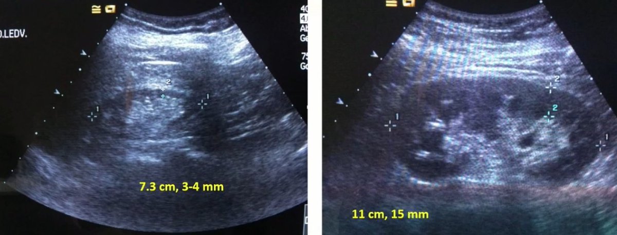 AvelRomanNeph's tweet image. Diferencia entre riñon normal y un riñon atrófico 

🧐

#interventionalNephrology #INFellow #POCuSFirst