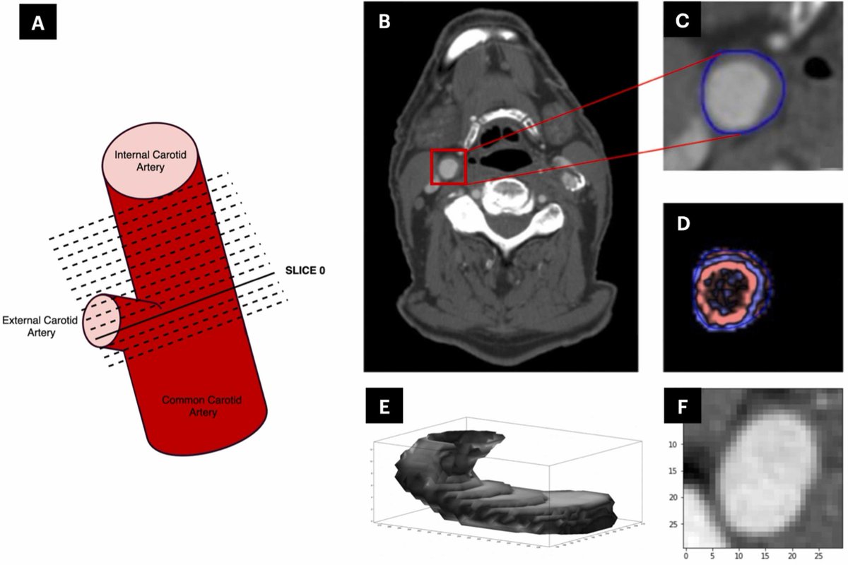 James Rudd (@jhfrudd) on Twitter photo Using machine learning to predict carotid artery symptoms from CT angiography: A radiomics and deep learning approach: bit.ly/4ef0rQF <a href="/Jmtarkin/">Jason Tarkin</a> <a href="/JWeirMcCall/">Jonathan Weir-McCall</a> <a href="/HLRI_Cambridge/">VPD Heart & Lung Research Institute</a> <a href="/rouchelle45/">Rouchelle Sriranjan Rothwell</a> <a href="/andrejcorovic/">Andrej Corovic</a> <a href="/nr_evans/">Nicholas Evans</a> <a href="/caromitreka/">Carola-Bibiane Schönlieb</a> <a href="/EvisSala/">Evis Sala</a> <a href="/MedCambridge/">Medicine at Cambridge</a> <a href="/Cambridgecardio/">CambridgeCardio</a> Using machine learning to predict carotid artery symptoms from CT angiography: A radiomics and deep learning approach: bit.ly/4ef0rQF <a href="/Jmtarkin/">Jason Tarkin</a> <a href="/JWeirMcCall/">Jonathan Weir-McCall</a> <a href="/HLRI_Cambridge/">VPD Heart & Lung Research Institute</a> <a href="/rouchelle45/">Rouchelle Sriranjan Rothwell</a> <a href="/andrejcorovic/">Andrej Corovic</a> <a href="/nr_evans/">Nicholas Evans</a> <a href="/caromitreka/">Carola-Bibiane Schönlieb</a> <a href="/EvisSala/">Evis Sala</a> <a href="/MedCambridge/">Medicine at Cambridge</a> <a href="/Cambridgecardio/">CambridgeCardio</a>