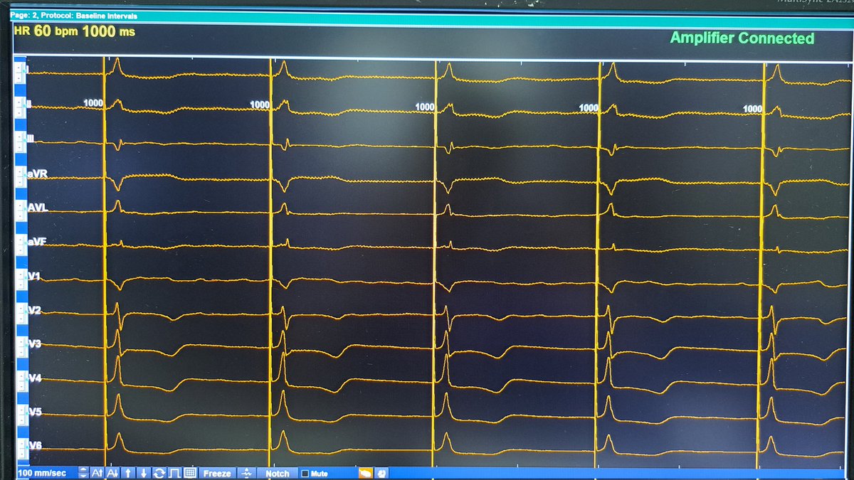 Teresa_Moraleda (@teremoraleda) on Twitter photo 69 y.o. female with LV dysfunction due to LBBB and uncontrolled AF. HB-CRT in the previous month. Today, AV node ablation achieving perfect restoration of electrical synchrony. Final His threshold with LBBB correction: 1.25@0.6 ms. 69 y.o. female with LV dysfunction due to LBBB and uncontrolled AF. HB-CRT in the previous month. Today, AV node ablation achieving perfect restoration of electrical synchrony. Final His threshold with LBBB correction: 1.25@0.6 ms.