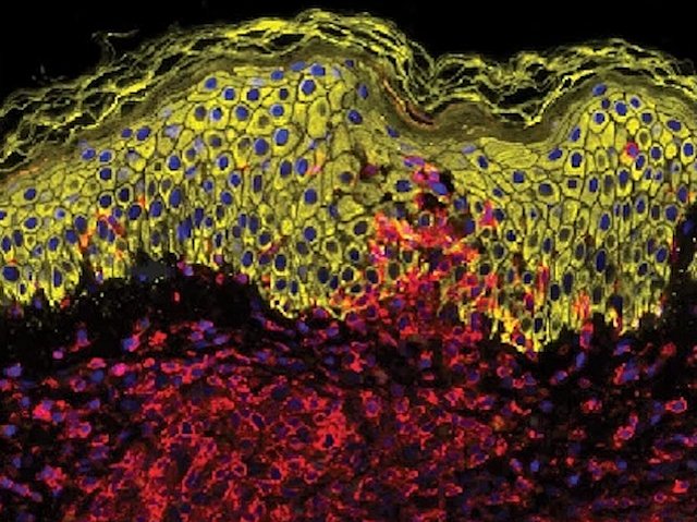 Biomedical Picture of the Day BPoD (@bpod_s) on Twitter photo Interferons & STAT1 pathways underlie often fatal skin reaction toxic epidermal necrolysis – JAK inhibitors are potential cures
đź“·:<a href="/NordmannThierry/">Thierry Nordmann</a> et al <a href="/labs_mann/">Matthias Mann Lab</a> <a href="/MPI_Biochem/">Max Planck Institute of Biochemistry (MPIB)</a> in <a href="/Nature/">nature</a>
➡️: bpod.org.uk/archive/2024/1… Interferons & STAT1 pathways underlie often fatal skin reaction toxic epidermal necrolysis – JAK inhibitors are potential cures
đź“·:<a href="/NordmannThierry/">Thierry Nordmann</a> et al <a href="/labs_mann/">Matthias Mann Lab</a> <a href="/MPI_Biochem/">Max Planck Institute of Biochemistry (MPIB)</a> in <a href="/Nature/">nature</a>
➡️: bpod.org.uk/archive/2024/1…