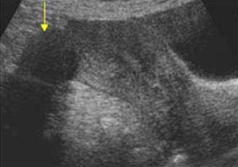 SirajBank's tweet photo. October 2024 🗓️

A 50-year-old female presents to the clinic complaining of heavy periods and abnormal uterine bleeding. An ultrasound is done and is shown below. Which of the following is the most likely diagnosis? https://t.co/zHaQfnrFKE