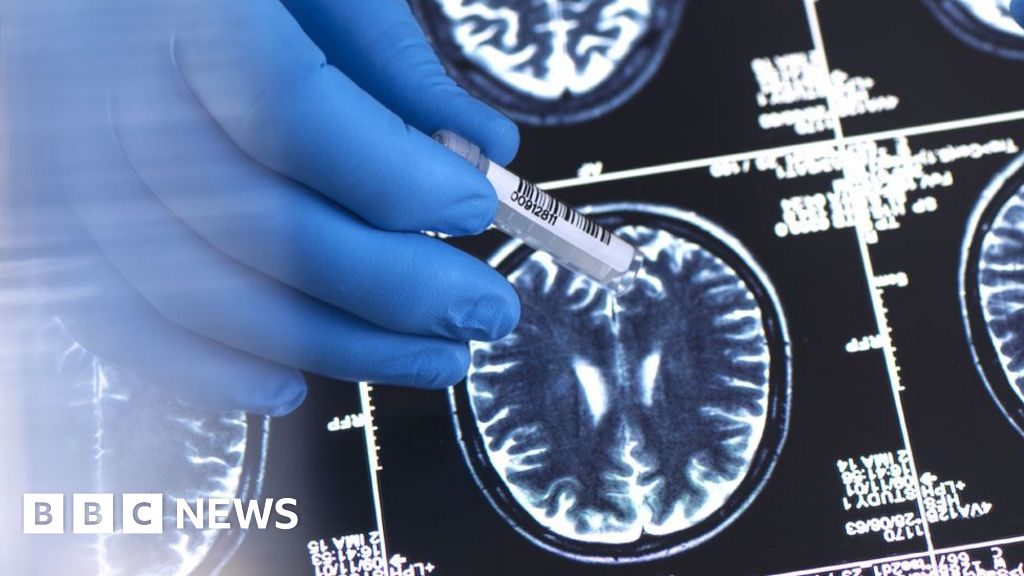 BECPAP's tweet photo. Our UK Friends! NHS will not fund new drug to slow Alzheimer’s https://t.co/TgOIqjzKn8 https://t.co/fgyEIoPoFr https://t.co/5fYlOj7nqi