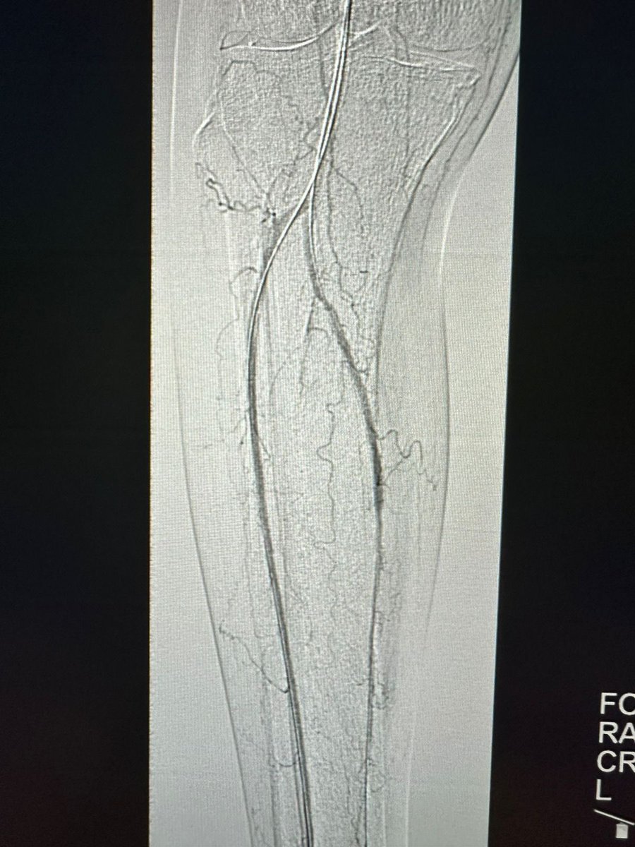 د.سلطان رباح الحربي | Dr. Sultan R.Alharbi (@sultan61633) on Twitter photo At #IR unit in #ksu patient with Critical limb ischemia and non healing wound treated using two advanced angioplasty techniques:
ATA: antegrade subintimal crossing
PTA: SAFARI
<a href="/ksumedicalcity/">المدينة الطبية الجامعية</a> <a href="/_KSU/">جامعة الملك سعود</a> <a href="/IRADKSU/">عيادات الأشعة التداخلية</a> At #IR unit in #ksu patient with Critical limb ischemia and non healing wound treated using two advanced angioplasty techniques:
ATA: antegrade subintimal crossing
PTA: SAFARI
<a href="/ksumedicalcity/">المدينة الطبية الجامعية</a> <a href="/_KSU/">جامعة الملك سعود</a> <a href="/IRADKSU/">عيادات الأشعة التداخلية</a>