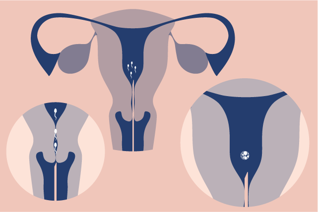¿Quién es el paciente ideal de una Inseminación Artificial Conyugal? Descúbrelo en nuestro blog de mano de nuestra experta en Embriología y Asesora en Fertilidad, Alba Alarcón Escudero. 🔗 mundofertilidad.com/expertos/a-qui…