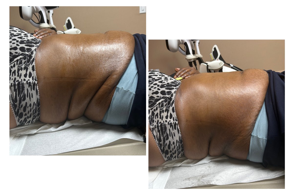 nirvanaconyers's tweet photo. 360 body contouring treatment!
Contact us at 470 974 9879 or visit https://t.co/4xL8lgweBG
#BodyContouring #360Transformation #BeforeAndAfter #BodyGoals #FatLossJourney
#SculptedBody #AestheticClinic #ContourYourBody #ConfidenceBoost #TransformYourself #MedicalAesthetics https://t.co/IH1GtyjrYe