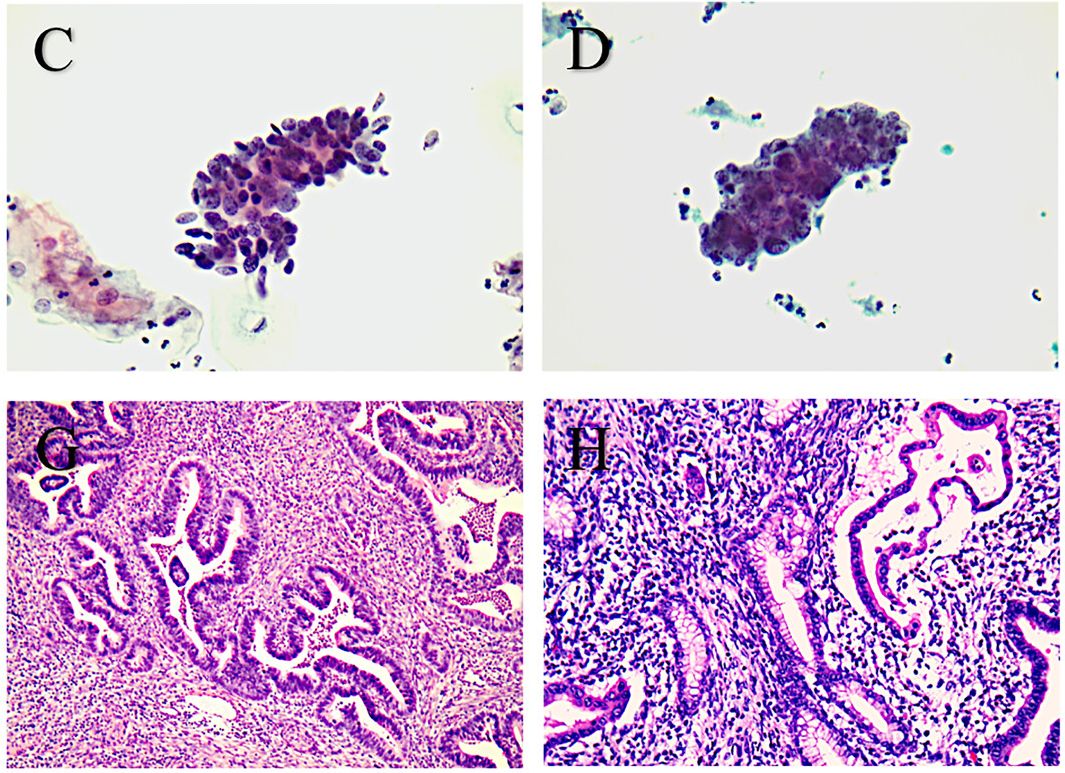 🔬 Retrospective analysis of #cytology and high-risk HPV testing in 1067 endocervical adenocarcinomas and precursor lesions

acsjournals.onlinelibrary.wiley.com/doi/full/10.10…

#cytopath #gynpath