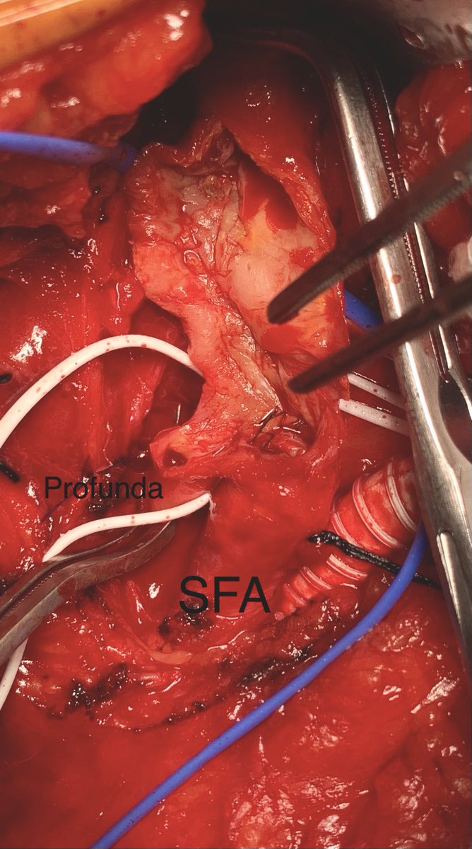 Please avoid #stenting across profunda.  Image may look good initially, but over time Neointimal hyperplasia will cause occlusion and bad problems.  Permission to post. <a href="/VascularSVS/">Society for Vascular Surgery</a> <a href="/FutureVascSurgn/">FutureVascSurgeons</a> #vascular #surgery