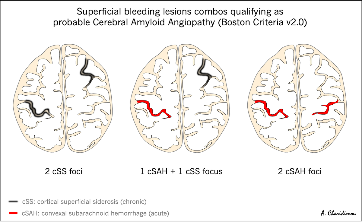 🧠🩸 Probable Cerebral Amyloid Angiopathy
Superficial bleeding combos per Boston criteria v2.0

#NeuroTwitter #stroke #Neurology #neuropath #stroke #dementia #Alzheimers #biomarker #brain #MedStudentTwitter #AmyloidAngiopathy #CAA #cSVD #Neurosurgery #RadEd