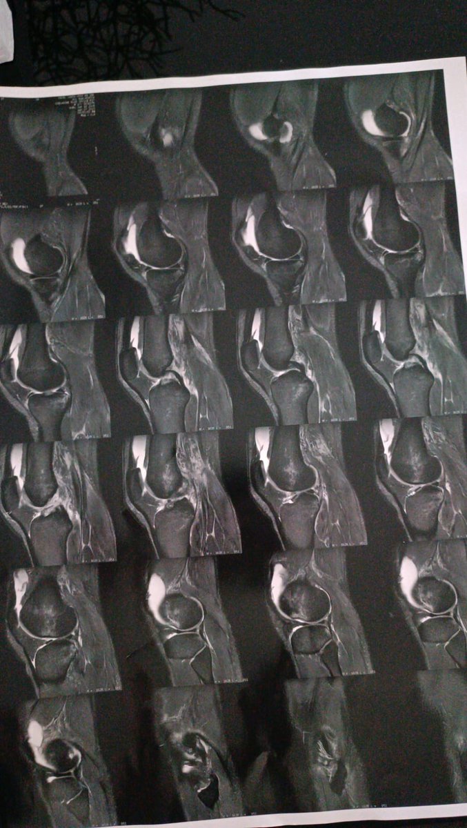 gpmentinha's tweet image. Fala pessoal!
Hoje eu quero falar sobre uma coisa mais séria.
Bom, me chamo Guilherme Pimenta, eu sofri um acidente, acabei rompendo o ligamento cruzado anterior. Já estou há mais de um ano lesionado e a cirurgia não vai ser tão breve assim, pois, estou aguardando o SUS.
