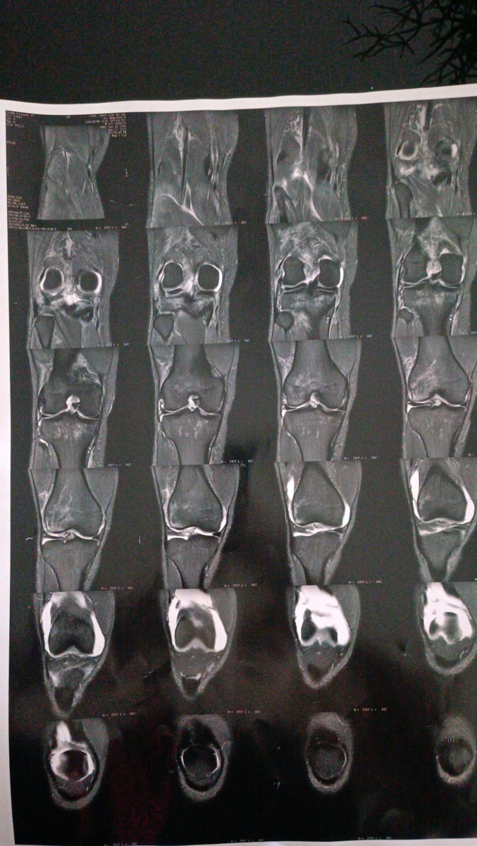 gpmentinha's tweet image. Fala pessoal!
Hoje eu quero falar sobre uma coisa mais séria.
Bom, me chamo Guilherme Pimenta, eu sofri um acidente, acabei rompendo o ligamento cruzado anterior. Já estou há mais de um ano lesionado e a cirurgia não vai ser tão breve assim, pois, estou aguardando o SUS.