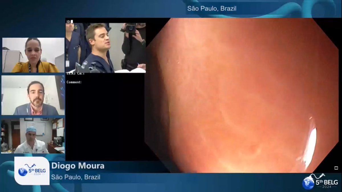 Bariatric Endoscopy Live Global (@bariatriclive) on Twitter photo 💥starting now 💥
🪙Ileogastric anastomosis enlargement with magnets for weight regain after gastric bipartition 🪙
🇧🇷🇧🇷Perform by <a href="/DiogoPhd/">Diogo Moura</a> 🇧🇷🇧🇷
bariatricendoscopylive.com 💥starting now 💥
🪙Ileogastric anastomosis enlargement with magnets for weight regain after gastric bipartition 🪙
🇧🇷🇧🇷Perform by <a href="/DiogoPhd/">Diogo Moura</a> 🇧🇷🇧🇷
bariatricendoscopylive.com